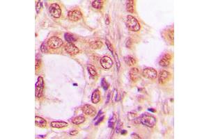 Immunohistochemical analysis of PRPF19 staining in human breast cancer formalin fixed paraffin embedded tissue section. (PRP19 抗体  (Center))