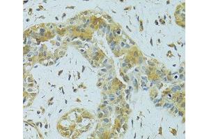 Immunohistochemistry of paraffin-embedded Human breast cancer using MTCH1 Polyclonal Antibody at dilution of 1:100 (40x lens). (MTCH1 抗体)