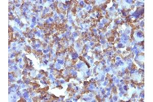 Formalin-fixed, paraffin-embedded human Histiocytoma stained with Macrophage Monoclonal Antibody (D11). (Macrophage / Histiocytoma Marker 抗体)