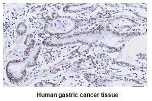 Paraffin embedded sections of human gastric canitrocelluloseer tissue were initrocelluloseubated with anti-human kLF4 (1:50) for 2 hours at room temperature. (KLF4 抗体  (AA 1-170))