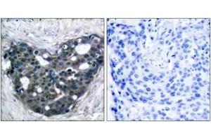 Immunohistochemistry analysis of paraffin-embedded human breast carcinoma tissue, using p56 Dok-2 (Ab-299) Antibody. (DOK2 抗体  (AA 266-315))