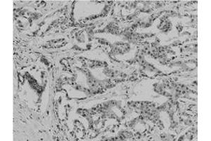 Immunohistochemical staining of paraffin-embedded human breast carcinoma tissue reacted with Acetyl lysine monoclonal antibody  at 1:200-1:500 dilution. (Acetylated Lysine 抗体  (acetylated))