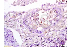 Formalin-fixed and paraffin embedded human lung cancer tissue labeled with Anti-RAP1A Polyclonal Antibody, Unconjugated (ABIN687472) at 1:200 followed by conjugation to the secondary antibody, (SP-0023), and DAB staining (RAP1A 抗体  (AA 101-184))