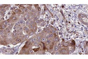 ABIN6276575 at 1/100 staining Human liver cancer tissue by IHC-P. (CAPNL1 抗体  (N-Term))