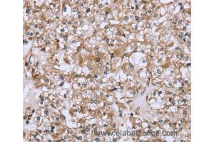 Immunohistochemistry of Human prostate cancer using FCAR Polyclonal Antibody at dilution of 1:20 (FCAR 抗体)
