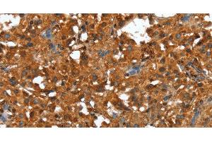 Immunohistochemistry of paraffin-embedded Human thyroid cancer using CTBP1 Polyclonal Antibody at dilution of 1:40 (CTBP1 抗体)