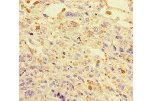 Immunohistochemistry of paraffin-embedded human melanoma using ABIN7150550 at dilution of 1:100 (DNAJC3 抗体  (AA 277-496))