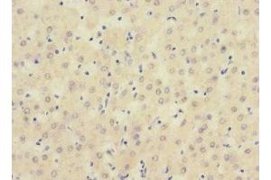 Immunohistochemistry of paraffin-embedded human liver cancer using ABIN7169723 at dilution of 1:100 (SIGIRR 抗体  (AA 1-120))