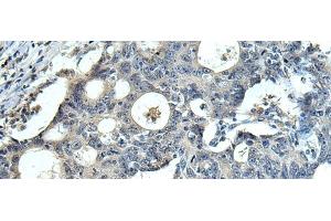 Immunohistochemistry of paraffin-embedded Human colorectal cancer tissue using FCRLA Polyclonal Antibody at dilution of 1:90(x200) (FCRLA 抗体)