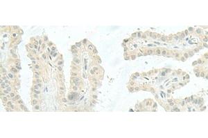 Immunohistochemistry of paraffin-embedded Human thyroid cancer tissue using MIEN1 Polyclonal Antibody at dilution of 1:45(x200) (C17orf37 抗体)