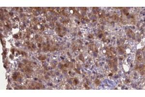 ABIN6276969 at 1/100 staining Human liver cancer tissue by IHC-P. (GRIK2 抗体  (Internal Region))