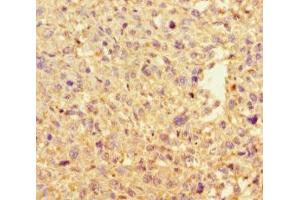 Immunohistochemistry of paraffin-embedded human melanoma using ABIN7150029 at dilution of 1:100 (DAAM2 抗体  (AA 1-101))