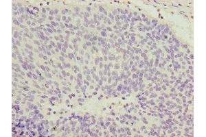 Immunohistochemistry of paraffin-embedded human cervical cancer using ABIN7148022 at dilution of 1:100 (COPZ1 抗体  (AA 1-177))