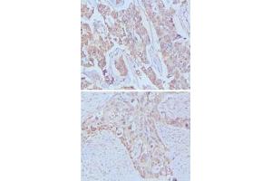 Immunohistochemical analysis of paraffin-embedded human breast cancer (upper) and lung cancer (bottom) tissues using EGF monoclonal antibody, clone 9D7F11  . (EGF 抗体)