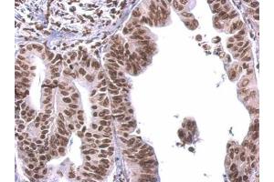 IHC-P Image COBRA1 antibody detects COBRA1 protein at nucleus on human gastric cancer by immunohistochemical analysis. (COBRA1 抗体  (Center))