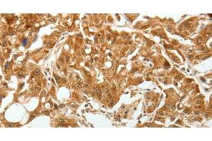 Immunohistochemistry of paraffin-embedded Human lung cancer tissue using TGF β Receptor I Polyclonal Antibody at dilution 1:60 (TGFBR1 抗体)