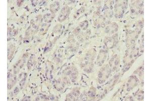 Immunohistochemistry of paraffin-embedded human liver cancer using ABIN7163403 at dilution of 1:100 (PHKG2 抗体  (AA 237-406))