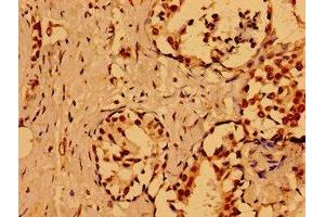 Immunohistochemistry of paraffin-embedded human breast cancer using ABIN7161807 at dilution of 1:100 (NUMA1 抗体  (AA 627-870))