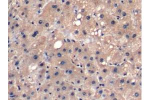 Detection of FGF21 in Human Liver cancer Tissue using Monoclonal Antibody to Fibroblast Growth Factor 21 (FGF21) (FGF21 抗体  (AA 29-209))