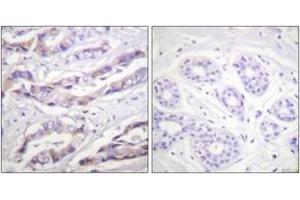Immunohistochemistry analysis of paraffin-embedded human breast carcinoma, using p70 S6 Kinase (Phospho-Thr389) Antibody.