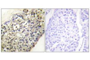 Immunohistochemistry analysis of paraffin-embedded human breast carcinoma tissue, using LATH antibody.