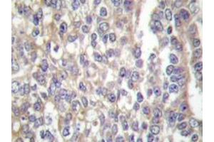 Immunohistochemistry  analyzes of Shc antibody in paraffin-embedded human breast carcinoma tissue. (SHC1 抗体)