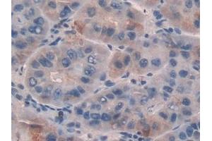 Detection of GDF5 in Human Liver cancer Tissue using Polyclonal Antibody to Growth Differentiation Factor 5 (GDF5) (GDF5 抗体  (AA 86-501))