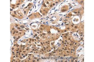 Immunohistochemistry of Human lung cancer using YWHAE Polyclonal Antibody at dilution of 1:100 (YWHAE 抗体)