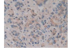 IHC-P analysis of Human Prostate Gland Cancer Tissue, with DAB staining. (HPR 抗体  (AA 70-332))