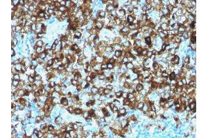 Formalin-fixed, paraffin-embedded human Melanoma stained with gp100 Rabbit Polyclonal Antibody. (Melanoma gp100 抗体)