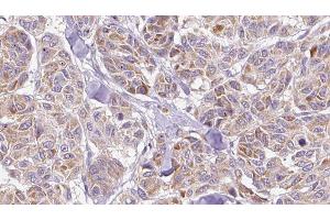 ABIN6278488 at 1/100 staining Human Melanoma tissue by IHC-P. (CCL3 抗体  (Internal Region))
