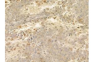 ABIN6258772 and ABIN6274897 at 1/100 staining human melanoma by IHC-P. (EPB41L2 抗体  (Internal Region))