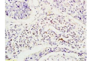 Formalin-fixed and human esophageal cancer tissue labeled with Anti-Phospho-CD19(Tyr531) Polyclonal Antibody, Unconjugated  at 1:200 followed by conjugation to the secondary antibody and DAB staining (CD19 抗体  (pTyr531))