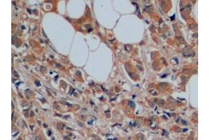 Detection of SERT in Human Breast cancer Tissue using Polyclonal Antibody to Serotonin Transporter (SERT) (SLC6A4 抗体  (AA 181-252))