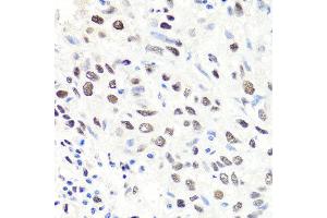Immunohistochemistry of paraffin-embedded human lung cancer using CBX1 antibody at dilution of 1:100 (x40 lens). (CBX1 抗体)