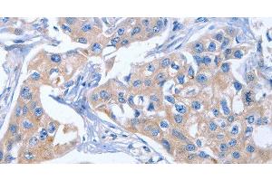 Immunohistochemistry of paraffin-embedded Human breast cancer tissue using IBSP Polyclonal Antibody at dilution of 1:50 (IBSP 抗体)