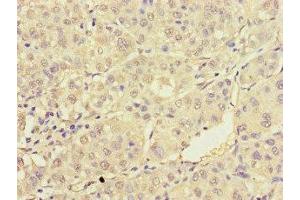 Immunohistochemistry of paraffin-embedded human liver cancer using ABIN7172232 at dilution of 1:100 (TRAF2 抗体  (AA 147-281))