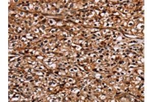 The image on the left is immunohistochemistry of paraffin-embedded Human prostate cancer tissue using ABIN7130441(NOC2L Antibody) at dilution 1/20, on the right is treated with fusion protein. (NOC2L 抗体)