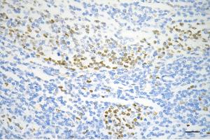 Immunohistochemistry was performed on paraffin-embedded human sigmoid colon carcinoma using MCM6 antibody (ABIN7799421), 1:200). (Recombinant MCM6 抗体)
