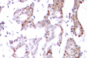 Immunohistochemistry (IHC) analysis of Elk1 antibody in paraffin-embedded human breast carcinoma tissue. (ELK1 抗体)