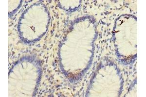Immunohistochemistry of paraffin-embedded human colon cancer using ABIN7171842 at dilution of 1:100