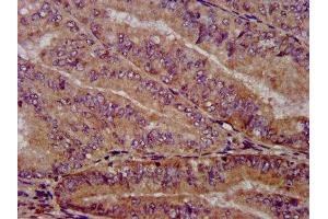 IHC image of ABIN7169262 diluted at 1:1000 and staining in paraffin-embedded human endometrial cancer performed on a Leica BondTM system. (PPP2R4 抗体  (AA 1-250))