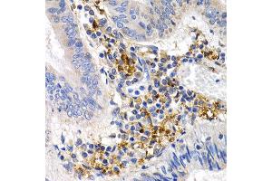 Immunohistochemistry of paraffin-embedded human colon cancer using GDF5 antibody at dilution of 1:200 (400x lens). (GDF5 抗体)