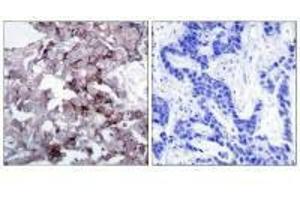 Immunohistochemistry analysis of paraffin-embedded human breast carcinoma tissue, using EGFR (Ab-1172) antibody. (EGFR 抗体  (Tyr1172))