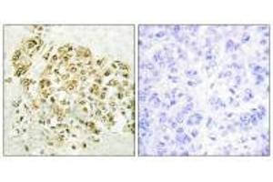 Immunohistochemistry analysis of paraffin-embedded human breast carcinoma tissue using MZF-1 antibody. (MZF1 抗体  (N-Term))