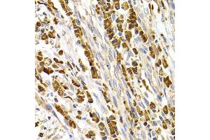 Immunohistochemistry of paraffin-embedded human stomach cancer using TACR3 antibody. (TACR3 抗体)