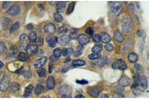 Immunohistochemistry (IHC) analyzes of p-ASK1 antibody in paraffin-embedded human breast carcinoma tissue (ASK1 抗体  (pSer966))