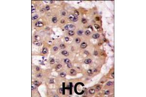 Formalin-fixed and paraffin-embedded human hepatocarcinoma tissue reacted with PSMA5 antibody , which was peroxidase-conjugated to the secondary antibody, followed by DAB staining. (PSMA5 抗体  (AA 106-135))