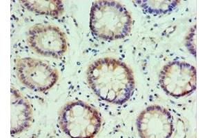 Immunohistochemistry of paraffin-embedded human colon cancer using ABIN7156617 at dilution of 1:100 (IRF2 抗体  (AA 120-349))