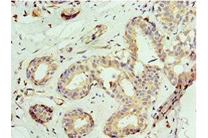 Immunohistochemistry of paraffin-embedded human breast cancer using ABIN7145038 at dilution of 1:100